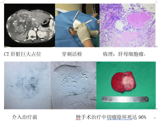 介入科醫(yī)生李炯：兒童出血性疾病、實體惡性腫瘤的介入治療