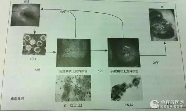 等了10年！宮頸癌疫苗終于要在內(nèi)地上市，就在明年年初！轉(zhuǎn)給身邊所有的女性！