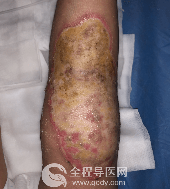 2歲男娃腿燙傷自敷草藥治療致高熱驚厥-兒童醫(yī)院燒傷科醫(yī)生談：燙傷應(yīng)如何處理？