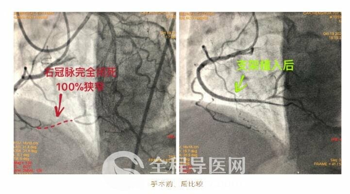 徐州市三院心臟團(tuán)隊(duì)于長(zhǎng)城心臟病學(xué)大會(huì)CTO論壇直播超高難度冠心病介入手術(shù)